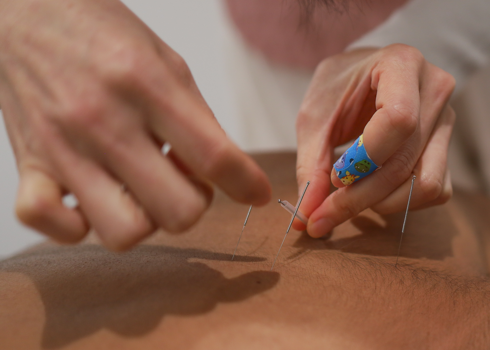 Acupuncture Treatment