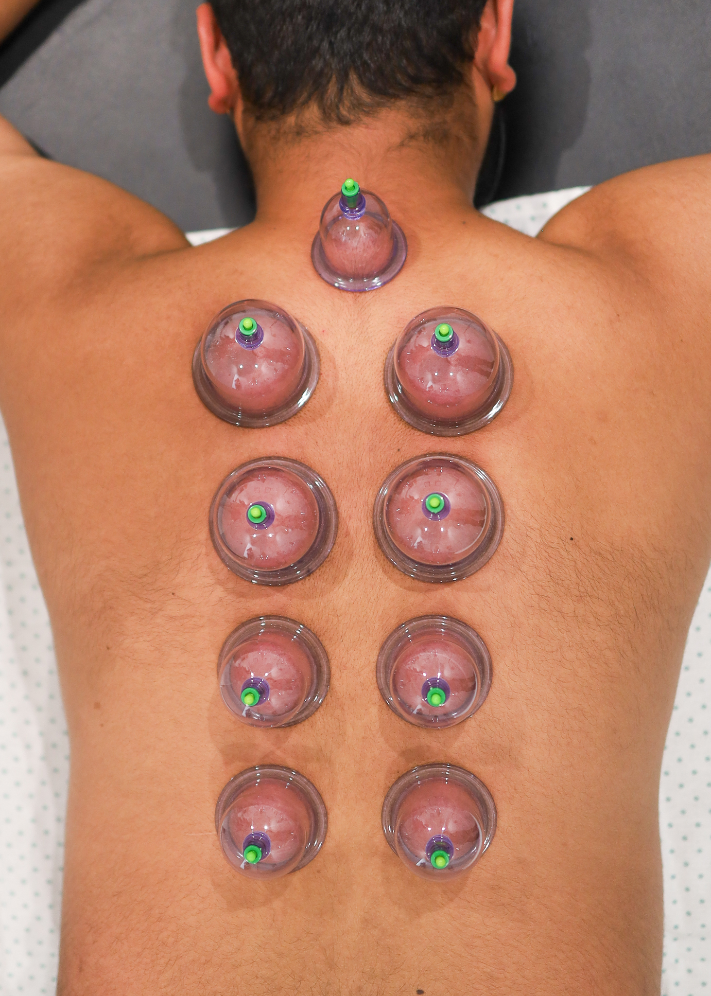 Cupping Therapy